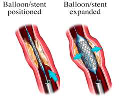 Balloon Stent diagram